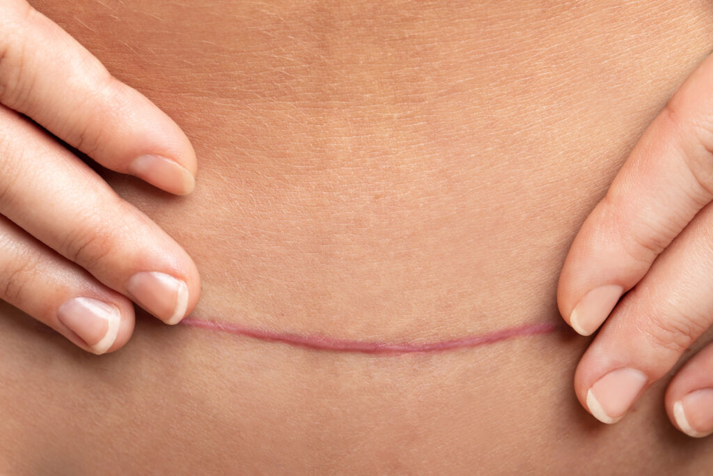 How to Recover from C-Section Complications